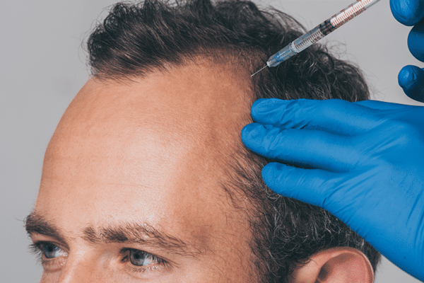 alternativas al trasplante capilar - hombre recibiendo una inyección de un tratamiento para la caída del cabello
