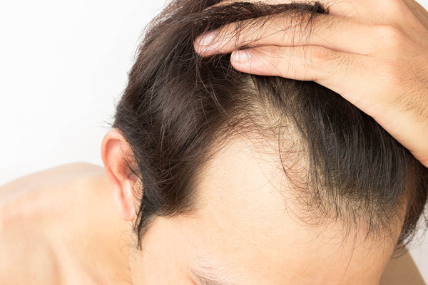 técnica FUE con implanters - hombre mostrando el avance de la alopecia en la línea del cabello y las entradas
