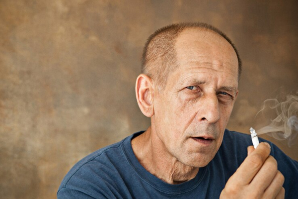 Fumar aumenta la caída del pelo - hombre mayor con problemas graves de alopecia con un cigarro encendido en la mano