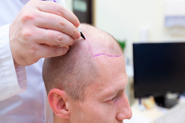 alternativas al trasplante capilar - hombre sentado en la consulta del tricólogo, el cual esta diseñando el implante de cabello