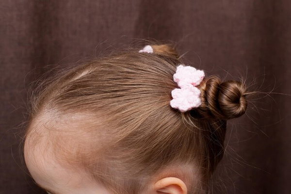 alopecia por tracción - niña pequeña con el cabello recogido en dos pequeños monos uno a cada lado de la cabeza