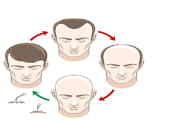 alternativas al trasplante capilar - esquema de la perdida del cabello incluyendo el trasplante capilar como solución