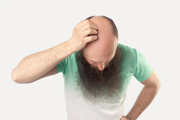 Donar pelo a otra persona - Hombre de larga barba agacha la cabeza y rasca una zona despoblada de su cuero cabelludo