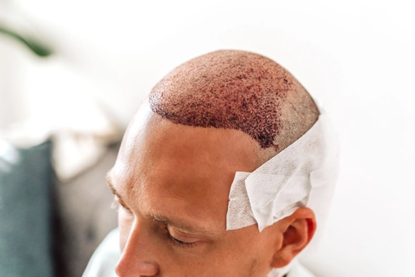 Caballero se recupera de un trasplante de cabello de gran extensión