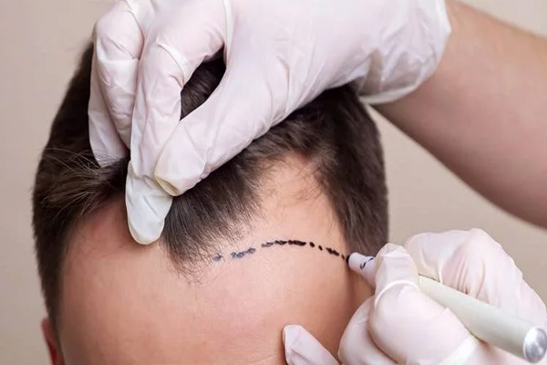 Cirujano dibuja línea de implantación frontal para proceder a concretar un trasplante capilar en la zona de la sien