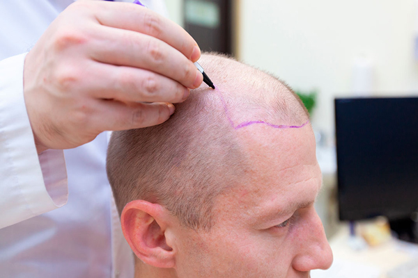 Zona donante - Cirujano capilar traza línea de implantación frontal en paciente con problemas de alopecia