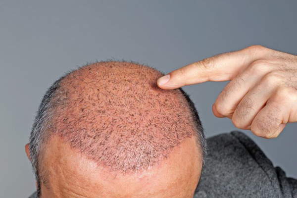 Donar pelo a otra persona - Hombre muestra avances de su injerto capilar meses después de la cirugía
