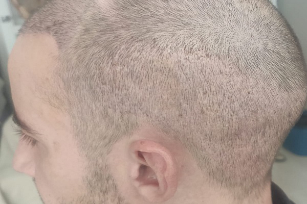 Hombre joven de perfil recupera de forma progresiva la densidad capilar en distintas áreas