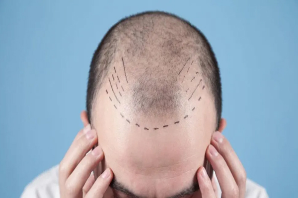 Donar pelo a otra persona - Hombre muestra los trazos de su línea implantación frontal para someterse a un injerto capilar