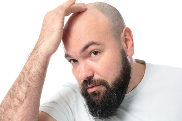 Donar pelo a otra persona - Hombre con problemas de alopecia sopesa la idea de sometrse a un injerto capilar para recuperar el cabello en la zona frontal de la cabeza