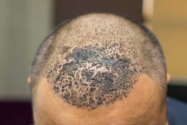 Hombre muestra como la cicatrización de trasplante capilar da lugar a la aparición de costras en la zona frontal