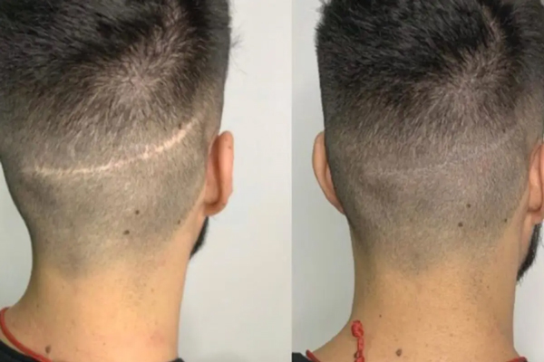 Antes y después de un joven con cicatriz en el cuero cabelludo tras recurrir a una micropigmentación capilar