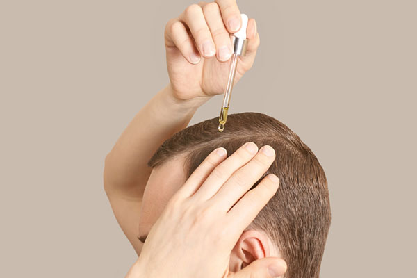 Joven rubio con peinado de medio lado aplica minoxidil en versión tópica para desacelerar los incipientes signos de alopecia