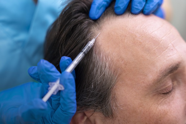 Hombre aplicándose un tratamiento de inyecciones de PRP, para fortalecer las hebras capilares y acelerar el crecimiento del pelo