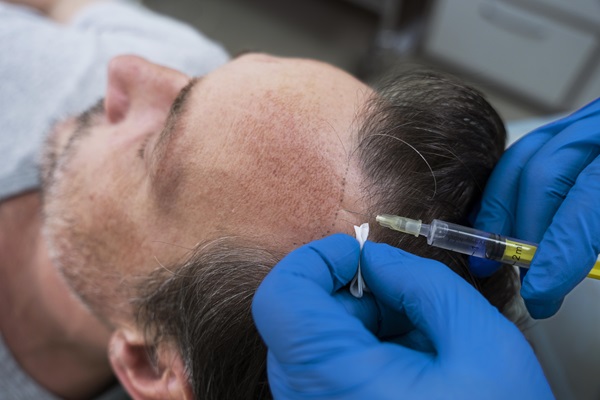 Técnica FUT/FUSS - Tricólogo realizando un tratamiento de implante capilar con la técnica FUT/FUSS a un paciente con alopecia