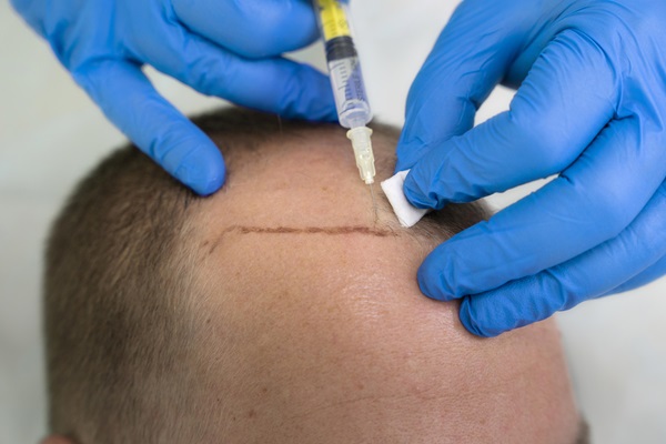 Doctor realizando el implante de cabello en un paciente con alopecia, siguiendo la línea del boceto para que recupere su cabellera