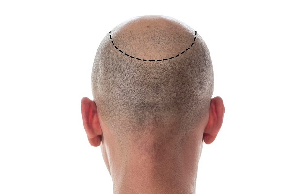 Boceto del trasplante de cabello que debe recibir un paciente con alopecia para recuperar su cabellera