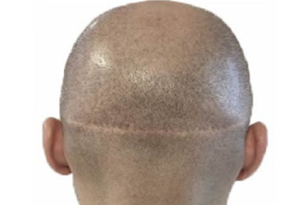 Técnica FUT/FUSS - Hombre de espalda mostrando la cicatriz que queda luego de realizar el implante capilar, la cual se puede disimular cuando crezca el cabello