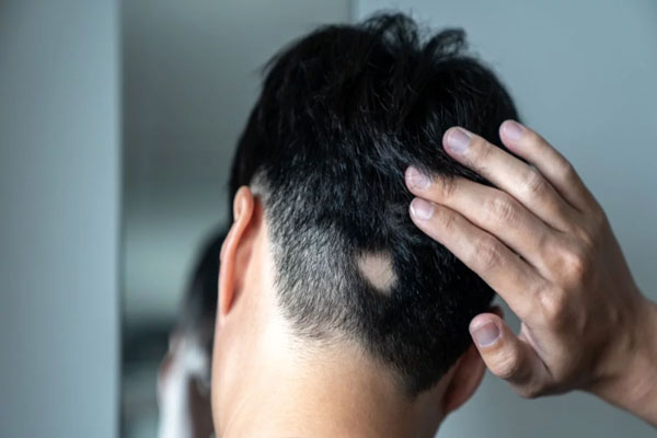 Caries y calvicie - Hombre de cabello negro se da la espalda para mostrar los irregulares parches que han aparecido en su cuero cabelludo 