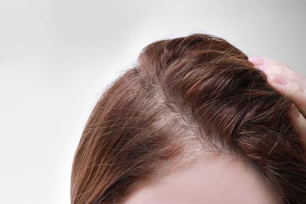 Mujer con principios de alopecia difusa cambia de peinado para disimular la pérdida de cabello