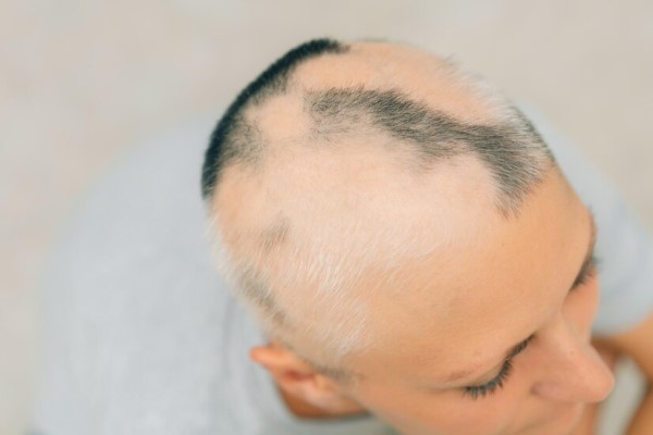 mujer con claros síntomas de alopecia areata en su cabeza