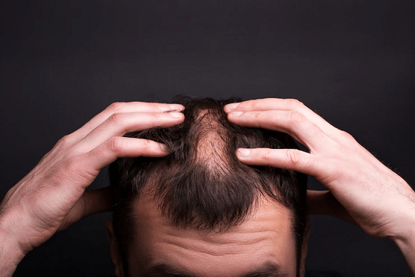 Alopecia en jóvenes - Joven con claros en la parte superior de la cabeza masajea su cuero cabelludo para mejorar la irrigación sanguínea que llega a los folículos pilosos