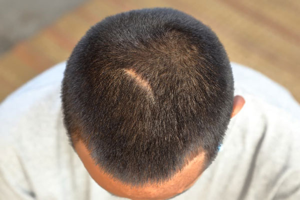 Injerto de pelo sobre cicatrices - Toma cenital de un hombre con cicatriz en la parte superior de la cabeza como parte de una valoración tricológica