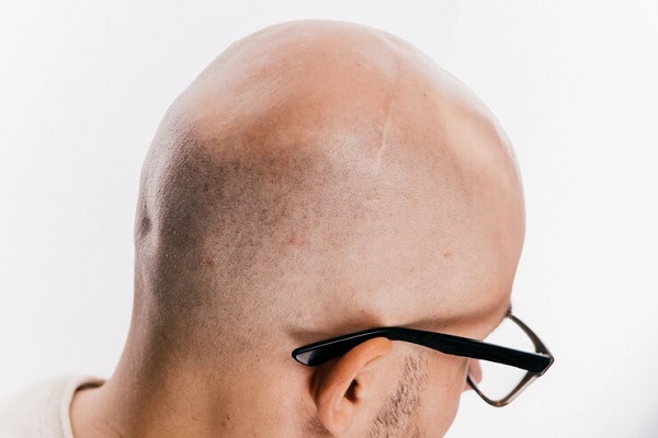 Injerto de pelo sobre cicatrices - Hombre con lentes se da la espalda para mostrar el estado de su cuero cabelludo