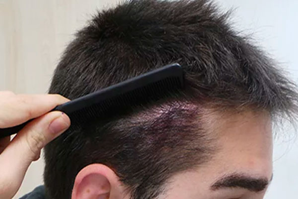 Injerto de pelo sobre cicatrices - Doctor usa un peine para ver la evolución de un trasplante de cabello sobre la cicatriz de un paciente