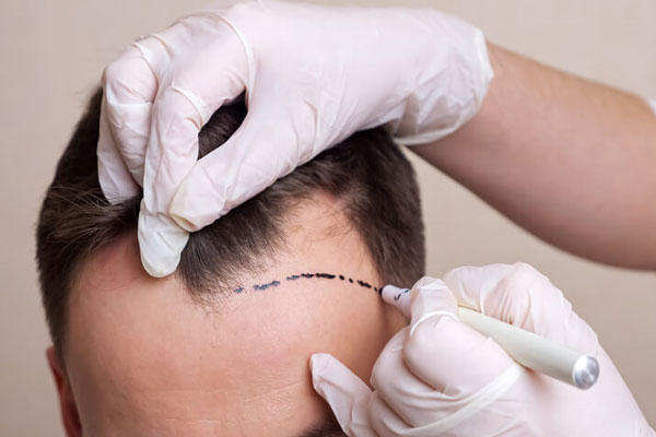 Cirujano capilar traza línea de implantación frontal como paso previo a un trasplante de cabello