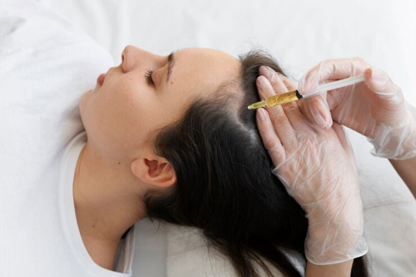 Alopecia juvenil - Tricólogo aplica microinyecciones de vitaminas para estimular el crecimiento del cabello en una paciente con problemas de alopecia