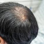 alopecia en jovénes