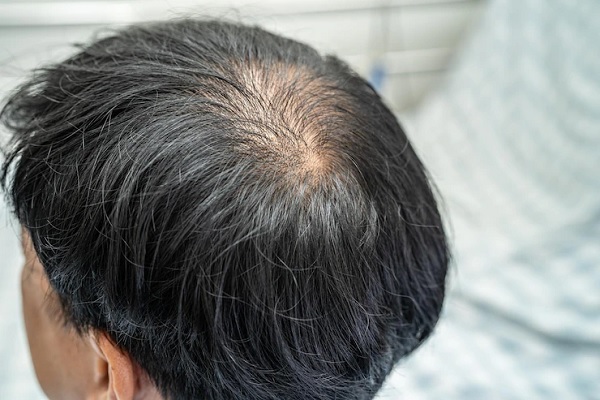 alopecia en jovénes