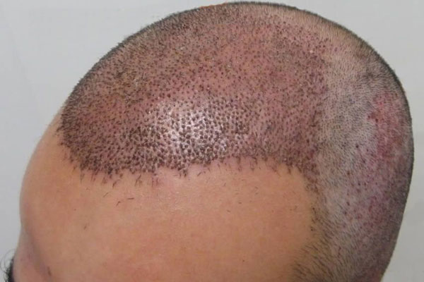 Vista del proceso de crecimiento de los nuevos folículos pilosos en un paciente con alopecia androgénica