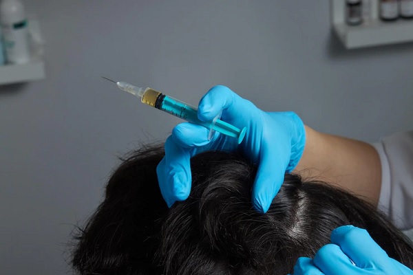 alopecia juvenil - Experto en salud capilar aplica microinyecciones para frenar la caída del cabello