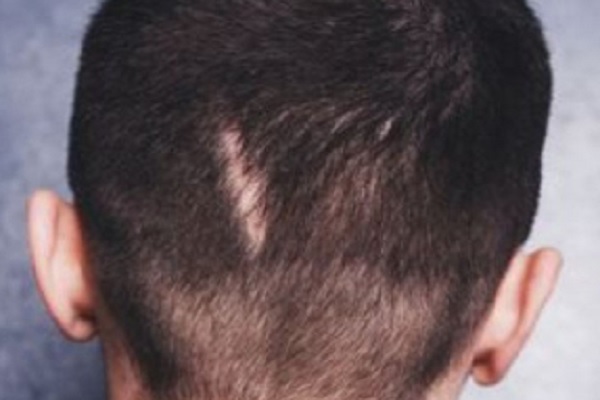 Injerto de pelo sobre cicatrices - Joven de se deja evaluar por un especialista tras recuperarse de una lesión en el cuero cabelludo