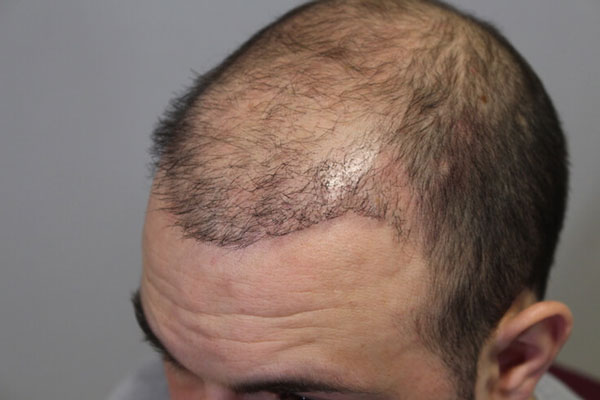Mal implante capilar - Hombre con escasa densidad capilar tras fallido trasplante de cabello 