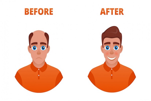Recomendaciones tras trasplante capilar - Imagen de un antes y después del implante capilar, el cual permite recuperar el cabello en las zonas afectadas por la alopecia