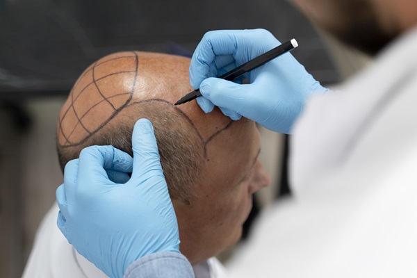 País para trasplante de pelo - Médico tricólogo realizando un boceto del implante de cabello a un paciente masculino con alopecia avanzada