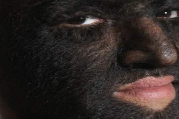 Hipertricosis - Plano detalle de un hombre con el rostro cubierto de pelo a causa de una rara enfermedad hereditaria