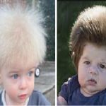 Síndrome del cabello impeinable - Fotos de dos casos de niños con síndrome de cabello impeinable