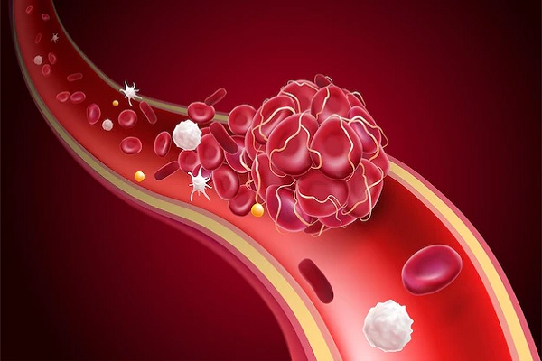 Alopecia y circulación sanguínea - Ilustración 3D de un coágulo de sangre obstruyendo la circulación sanguínea de un vena