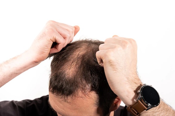 Alopecia y circulación sanguínea - Hombre con problemas de alopecia tira de su cabello 