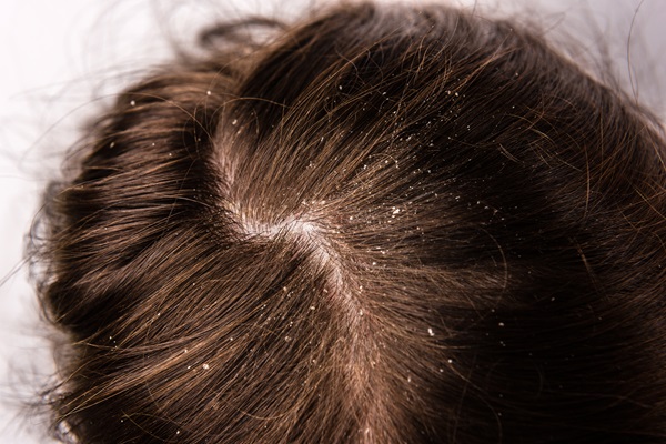 Caspa en los hombres - Vista superior de un cabello con muchas escamas blancas de caspa