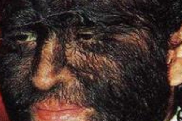 Hipertricosis - Parte del rostro de un sujeto con síndrome del hombre lobo
