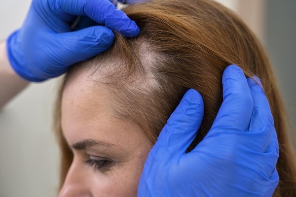 Síndrome de ovario poliquístico - Médico especialista evalúa el cuero cabelludo de una mujer joven con alopecia