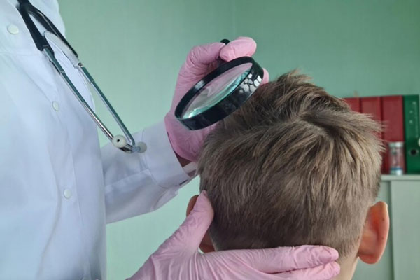 Síndrome del cabello impeinable - Tricólogo con lupa analiza el cuero cabelludo de un adolescente