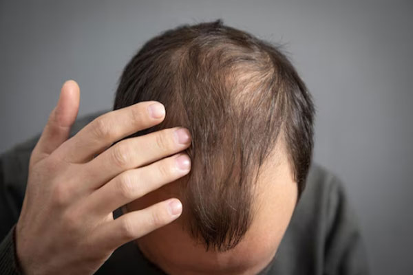 Plano detalle de la cabeza de un hombre con problemas de alopecia