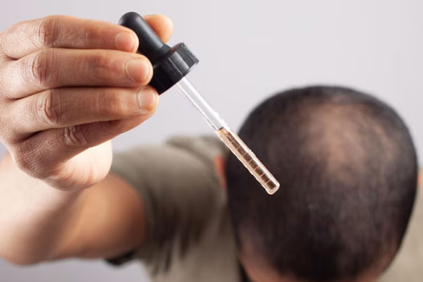 Efecto Shedding - Hombre sostiene un gotero con minoxidil para tratar la calvicie en la coronilla