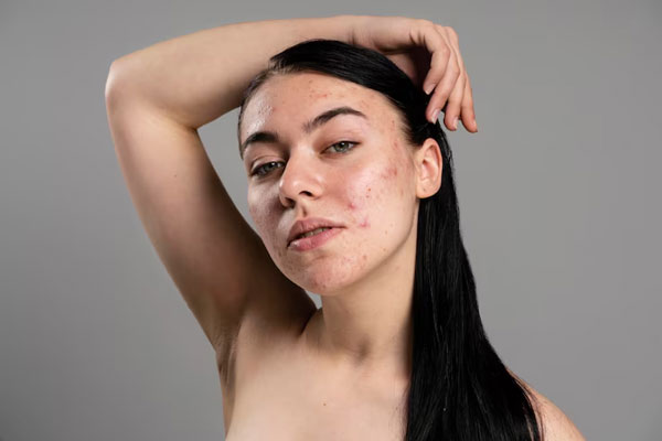 Hirsutismo hormonal - Joven de piel grasa presenta un brote de acné en el rostro